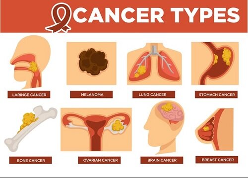 TYPES OF CANCER CAUSES, SYMPTOMS AND1 WHAT IS BEST TREATMENT