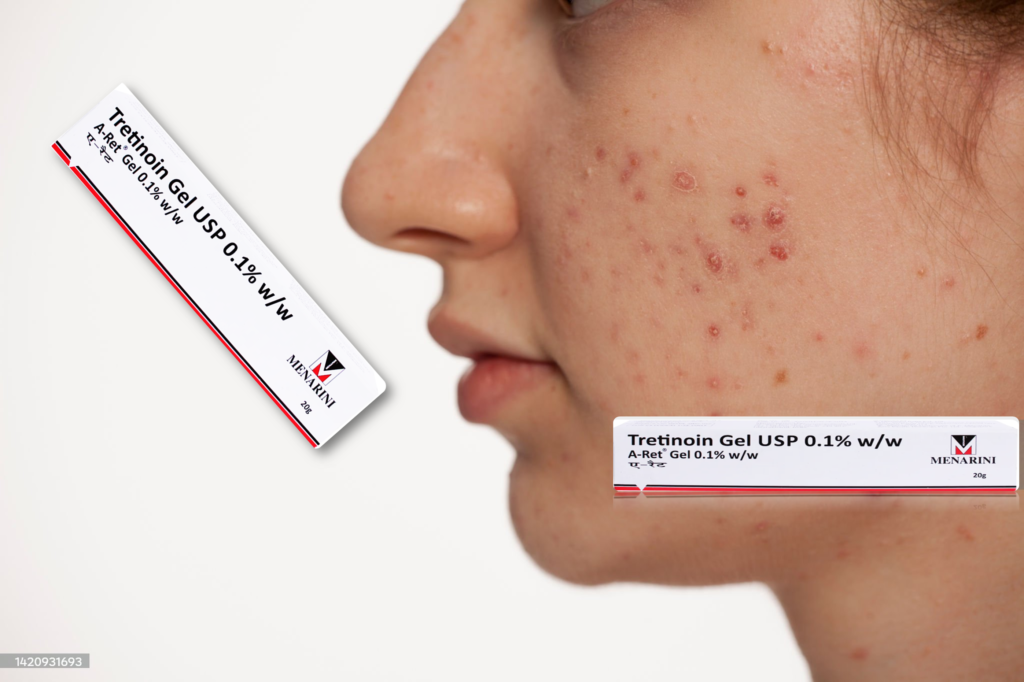 A Ret 0.1 Gel: Your Ultimate Solution for Acne-Free Skin!